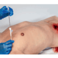 pneumothorax Chest decompression needle