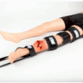 Traction Splint